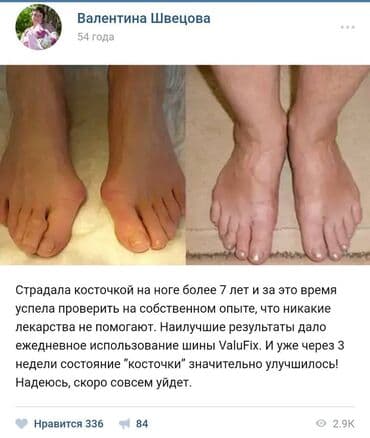 Кислородные подушки: Valufix- hallfix фиксатор от вальгусной деформации +бесплатная — 16