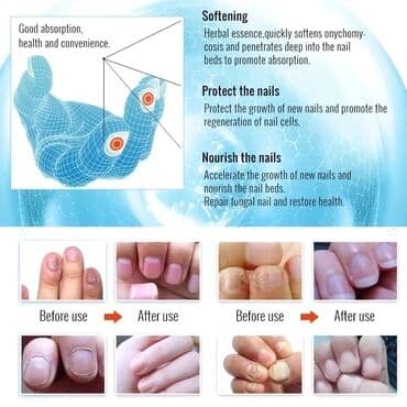 эко спрей от вшей как пользоваться: 🤍Эссенция для грибковых ногтей использует метод проникновения — 4