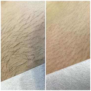 депилятор: Лазерная эпиляция — до/после Профессиональное удаление нежелательных — 3