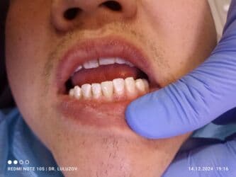 хиджама кровопускание: Клиника | Стоматолог | Протезирование — 12