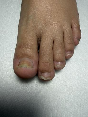 ноктя: Предлагается профессиональная услуга по лечению вросшего ногтя — 4