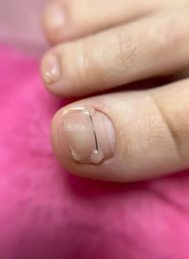 Коррекция вросших ногтей, Педикюр, С выездом на дом, Консультация, Одноразовые расходные материалы