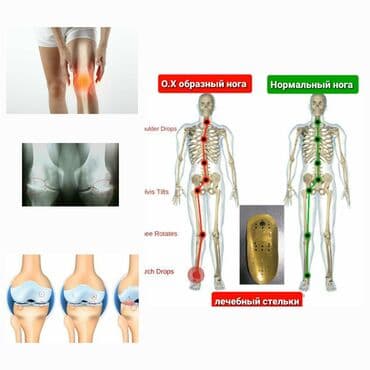 искры для обуви: Алтын батек кандайча иштейт? Гучженцзи ортопедиялык стелькилери — 1