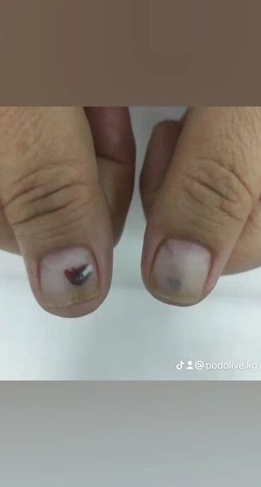 маникюр педикюр с выездом на дом: Коррекция вросших ногтей, Выравнивание, Услуги подолога, Маникюр, Педикюр, С выездом на дом, Консультация, Одноразовые расходные материалы — 5