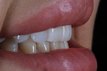 Медицина, фармацевтика: Эстетическая реставрация передних зубов: керамические виниры/коронки — 3