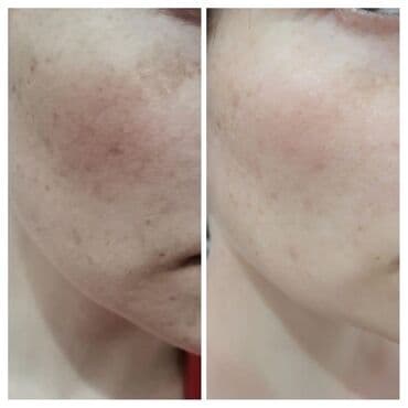 эффективный отбеливающий крем для зоны бикини в аптеке: Expigment Экспигмент Сроки до 2027 Свежая поставка с Турции 🇹🇷 💯% — 10