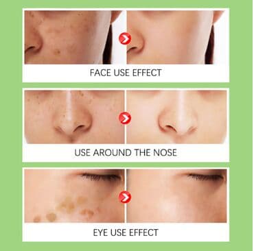 эффективный отбеливающий крем для зоны бикини в аптеке: ❄️ США Крем интенсивное отбеливание с Аmazon и Еbay Крем дает ▶ — 3