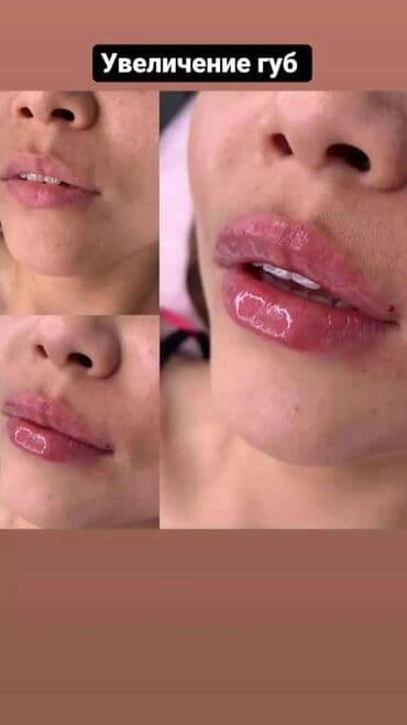 нейлоновые зубные протезы в бишкеке цены: Косметология, Ботокс, Биоревитализация, Ботулинотерапия, Консультация, Гипоаллергенные материалы, Сертифицированный косметолог — 7