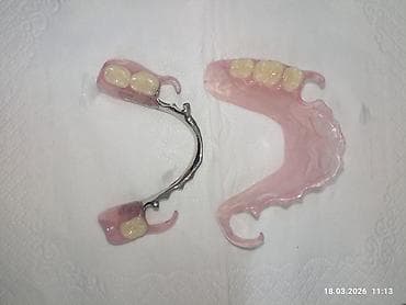 Съемные частичные зубные протезы - Тип: частичные протезы для верхней at lalafo.kg Съемные частичные зубные протезы - Тип: частичные протезы для верхней