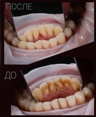 чистка топливной системы: Профессиональная гигиена полости рта: снятие зубного камня и — 1