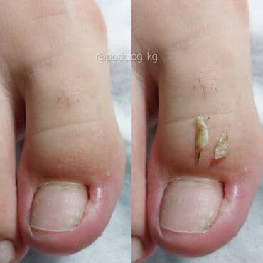 сколько стоит обучение на маникюр: Коррекция вросших ногтей, Услуги подолога, Педикюр, Одноразовые расходные материалы, Консультация — 6