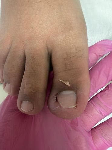 удаление папилом: Коррекция вросших ногтей, Педикюр, Одноразовые расходные материалы — 2