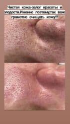 гель для узи: Комбинированная чистка лица: механическая + ультразвуковая — 5