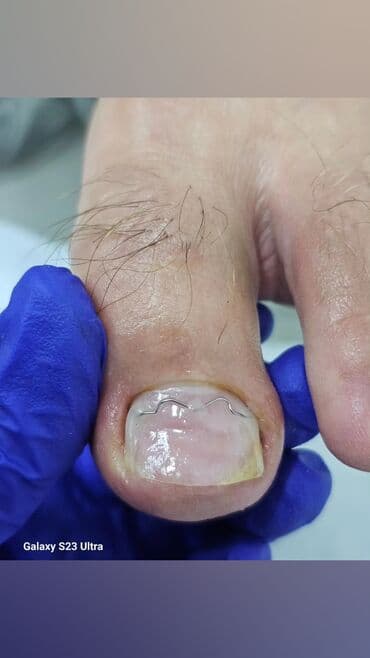 маникюр педикюр с выездом на дом: Коррекция вросших ногтей, Выравнивание, Услуги подолога, Маникюр, Педикюр, С выездом на дом, Консультация, Одноразовые расходные материалы — 10