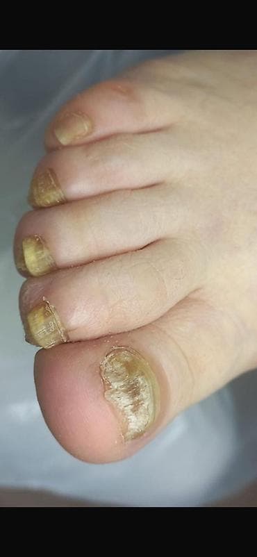 Коррекция вросших ногтей, Педикюр, Одноразовые расходные материалы