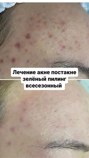 Косметолог с медицинским образованием чистка лица пилинг осветление