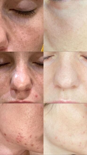 эффективный отбеливающий крем для зоны бикини в аптеке: Expigment Экспигмент Сроки до 2027 Свежая поставка с Турции 🇹🇷 💯% — 11