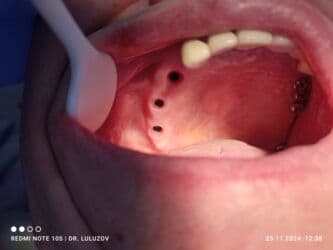 хиджама кровопускание: Клиника | Стоматолог | Протезирование — 17