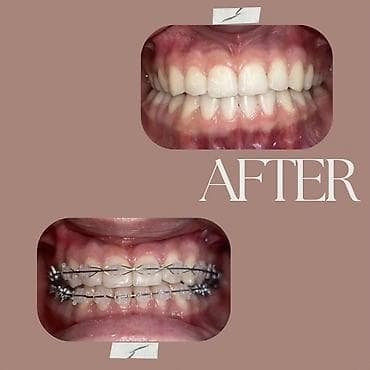 лечение гемороя: 1)Профессиональная 3-х этапная гигиена полости рта (ультразвук — 7