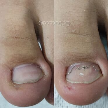 кресло барбер: Сынган тырмактарды оңдоо, Ичине кирип өскөн тырмактарды оңдоо, Педикюр, Консультация, Бир жолку сарпталуучу материалдар — 10