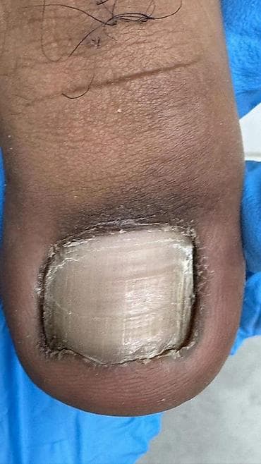 апарат станок: Коррекция вросших ногтей, Педикюр, Одноразовые расходные материалы — 2