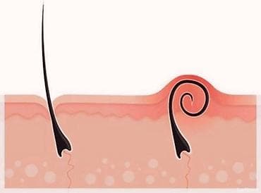 Массаж: Массаж | Көчүк нервинин кысылышы, Моюндагы өркөч — 3