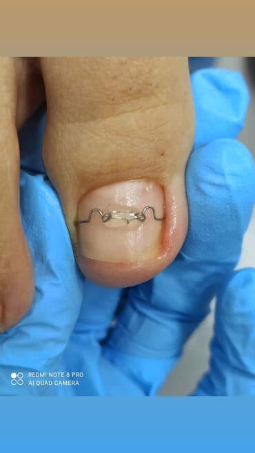 медсестра на дом бишкек мкр: Выравнивание, Наращивание ногтей, Донаращивание ногтей, Маникюр, Педикюр, Услуги подолога, С выездом на дом, Консультация, Одноразовые расходные материалы — 3