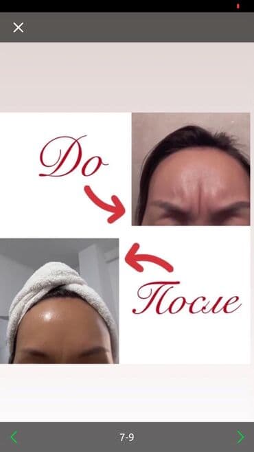 Косметология, Ботокс, Биоревитализация, Ботулинотерапия, Консультация, Гипоаллергенные материалы, Сертифицированный косметолог at lalafo.kg Косметология, Ботокс, Биоревитализация, Ботулинотерапия, Консультация, Гипоаллергенные материалы, Сертифицированный косметолог