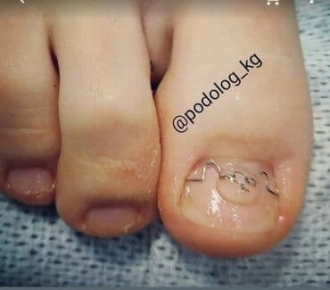 Снятие, Коррекция вросших ногтей, Японский маникюр, Услуги подолога, Маникюр, Педикюр, Консультация, Одноразовые расходные материалы