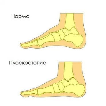 Медтовары: Стельки ортопедические(специализированные) от плоскостопия! Для — 3