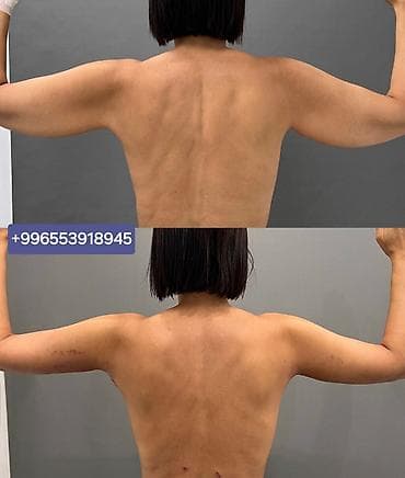 лицо: Липосакция второго подбородка и брыли по Акции вместо 35000с со — 10