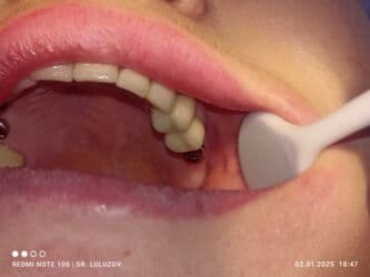 хиджама кровопускание: Клиника | Стоматолог | Протезирование — 9