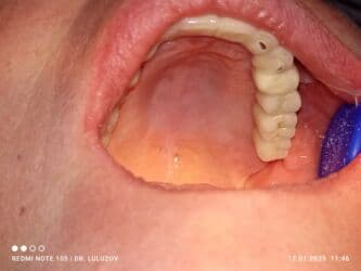 хиджама кровопускание: Клиника | Стоматолог | Протезирование — 10