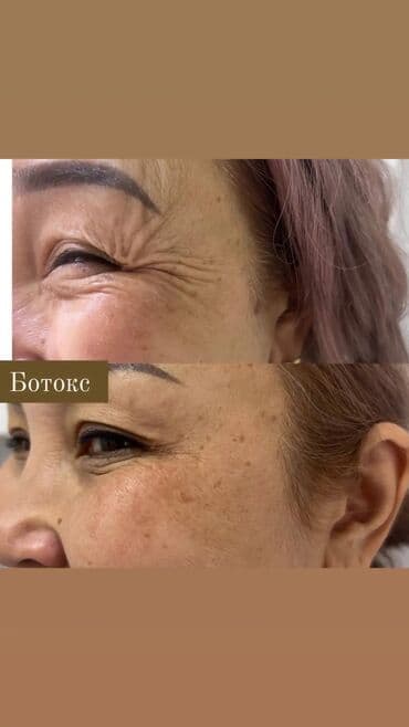 нейлоновые зубные протезы в бишкеке цены: Косметология, Ботокс, Биоревитализация, Ботулинотерапия, Консультация, Гипоаллергенные материалы, Сертифицированный косметолог — 10