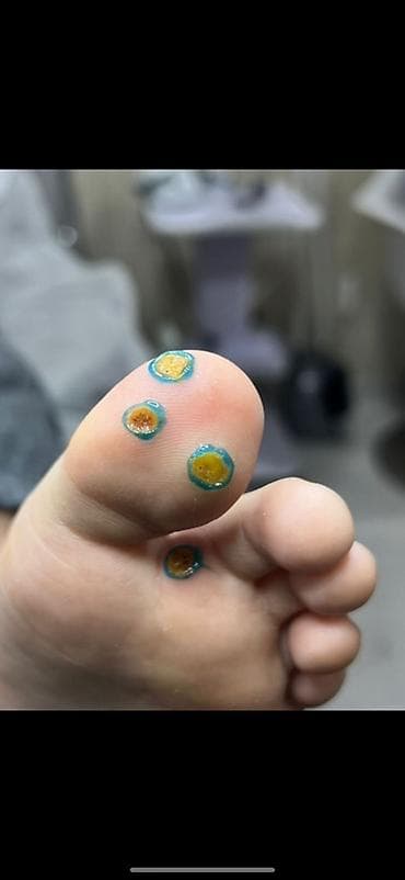 man: Коррекция вросших ногтей, Педикюр, С выездом на дом, Одноразовые расходные материалы, Требуются модели — 2