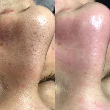 пилинг лица: Косметология, Маски, Массаж лица, Отбеливание пигментных пятен, Консультация, Гипоаллергенные материалы, Сертифицированный косметолог — 2