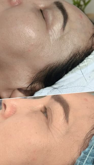 гель для узи: Процедура для лица: лифтинг и омоложение кожи вокруг глаз и скуловой — 1