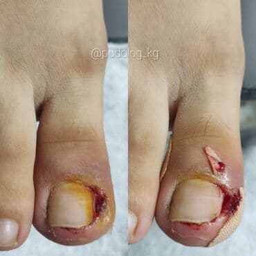 сколько стоит обучение на маникюр: Коррекция вросших ногтей, Услуги подолога, Педикюр, Одноразовые расходные материалы, Консультация — 9