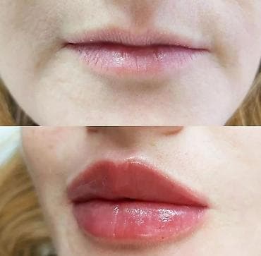 Все косметологические процедуры, лечение угревой болезни, #нитевой