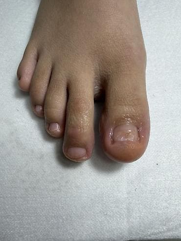 ноктя: Предлагается профессиональная услуга по лечению вросшего ногтя — 5