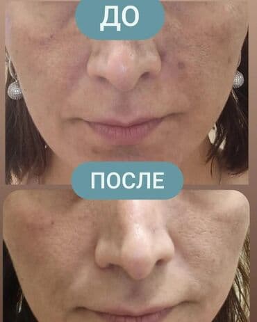 эффективный отбеливающий крем для зоны бикини в аптеке: Expigment Экспигмент Сроки до 2027 Свежая поставка с Турции 🇹🇷 💯% — 5