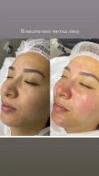 гель для узи: Комбинированная чистка лица: механическая + ультразвуковая — 9