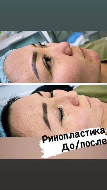 нейлоновые зубные протезы в бишкеке цены: Косметология, Ботокс, Биоревитализация, Ботулинотерапия, Консультация, Гипоаллергенные материалы, Сертифицированный косметолог — 2