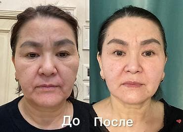 обувь медицинская: Безоперационная косметологическая процедура для омоложения лица. На — 1