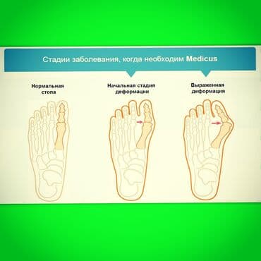 эспандер бабочка: Корректоры для большого пальца ноги от вальгусной деформации(косточки — 12