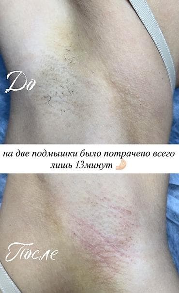Электроэпиляция удаление и коррекция растительности на любой части lalafo.kg да Электроэпиляция удаление и коррекция растительности на любой части