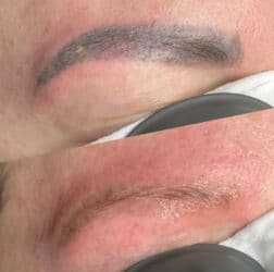 визажное кресло: Продаю лазерный аппарат для удаления татуажа, перманента, татуировок — 5