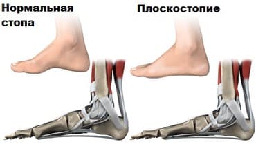 белорусская обувь для проблемных ног бишкек: Стельки ортопедические(специализированные) от плоскостопия Для — 1