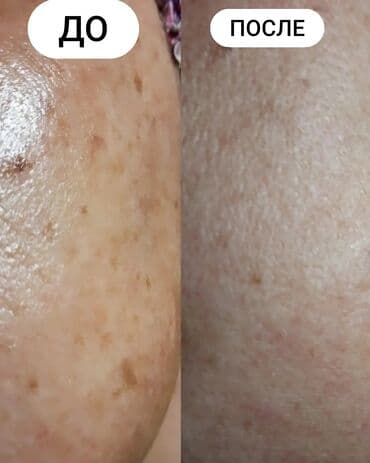 эффективный отбеливающий крем для зоны бикини в аптеке: Expigment Экспигмент Сроки до 2027 Свежая поставка с Турции 🇹🇷 💯% — 4