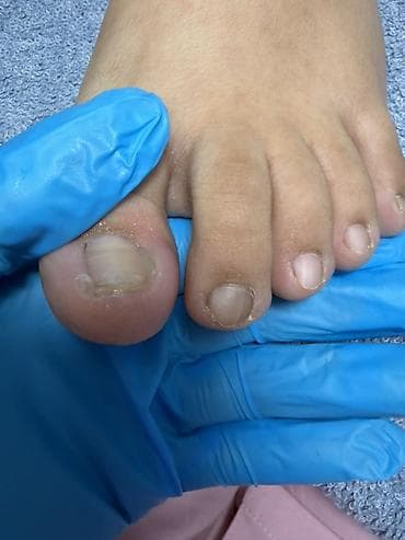 удаление папилом: Коррекция вросших ногтей, Педикюр, Одноразовые расходные материалы — 5